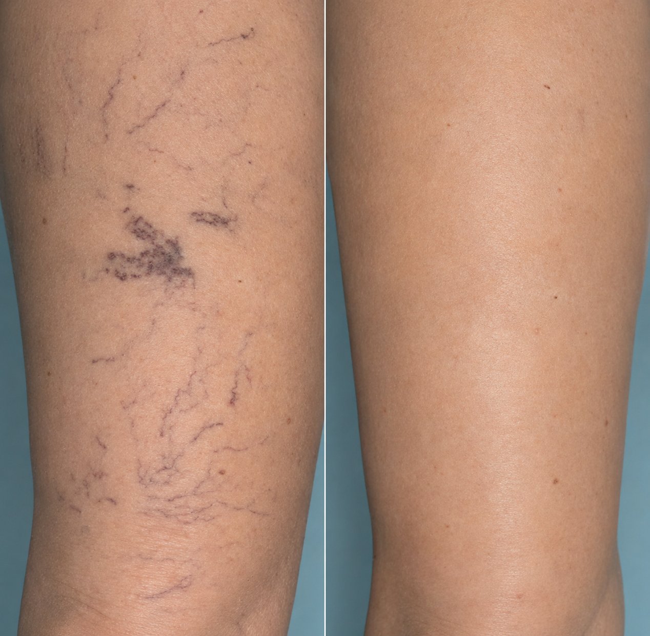 Before and after spider vein treatment in Georgetown TX near Sun City